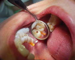 Karies am Zahn